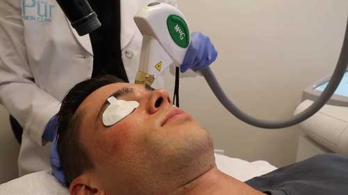 强脉冲光面部护理