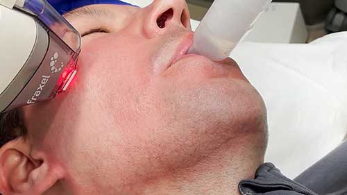 飞梭镭射抗衰老