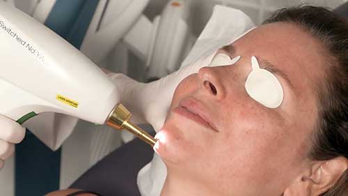 Q开关激光治疗：光损伤色斑