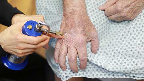 液氮冷冻手术简要介绍