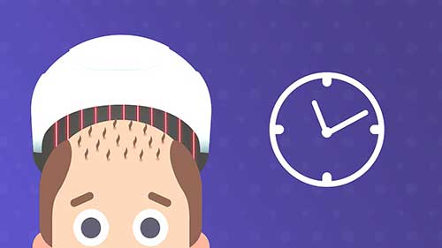 弱激光疗法与脱发