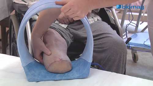 3D脉冲磁场治疗