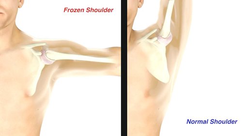冷冻肩的康复治疗
