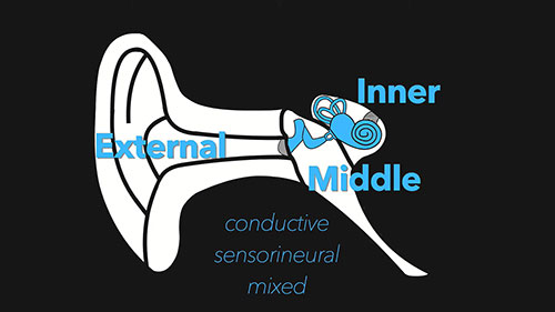听力损失和中耳构造