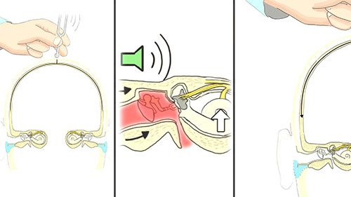 听力损失的临床检查