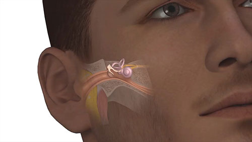 磁注射技术与听力损失