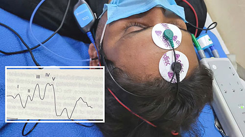 听性脑干反应的临床应用