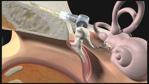 隐形听力辅助设备