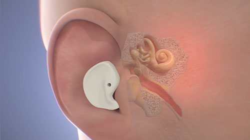 听力放大器和助听器