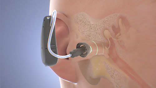 助听器的原理和类型