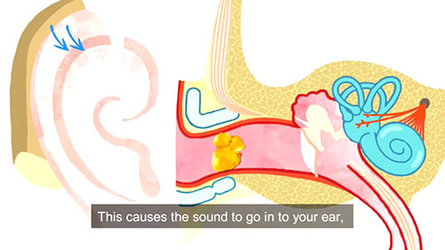 助听器的相关知识
