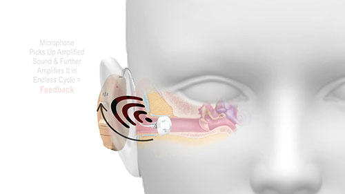 助听器啸叫的解决方法