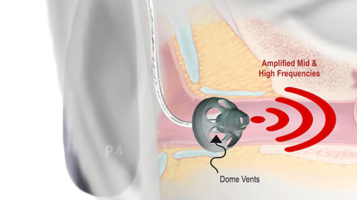 助听器圆顶和耳膜