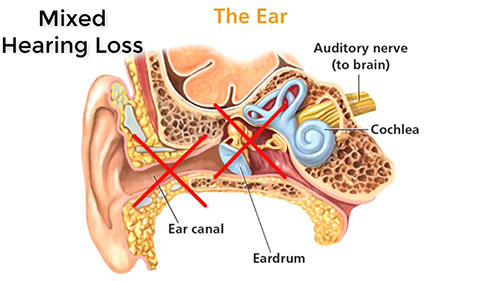 骨导助听器的工作原理