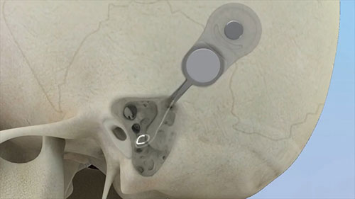 人工耳蜗植入手术动画