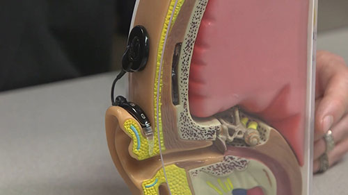 人工耳蜗的组成部件