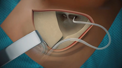 植入体的手术流程