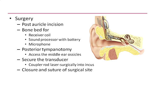 全植入式助听器