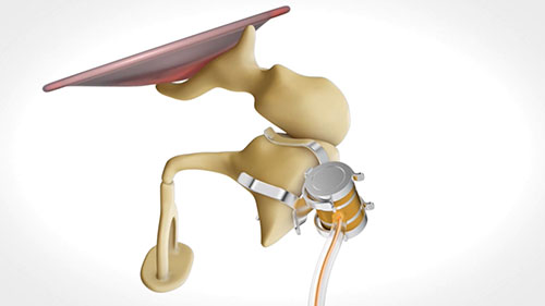 声桥植入的特点