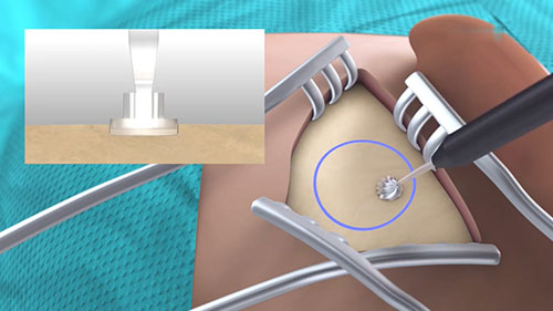 骨桥植入手术过程