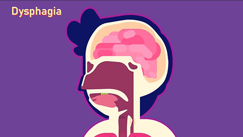 什么是吞咽障碍