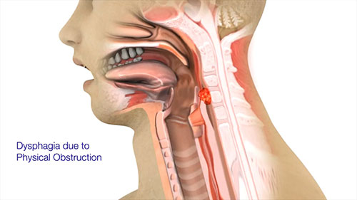 吞咽障碍的病因