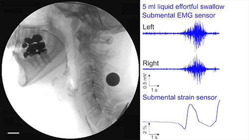 吞咽治疗的辅助装置