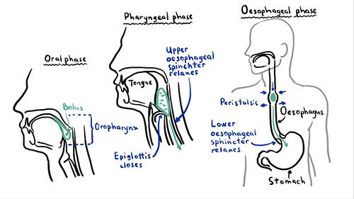 吞咽障碍的病因及治疗