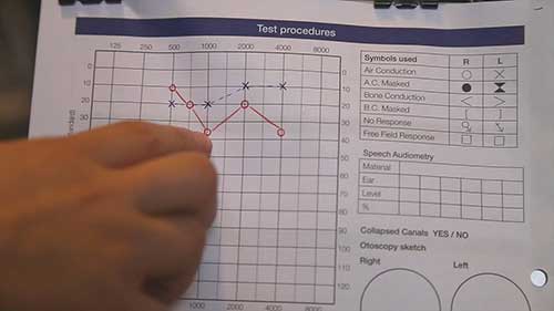 如何进行听力筛查