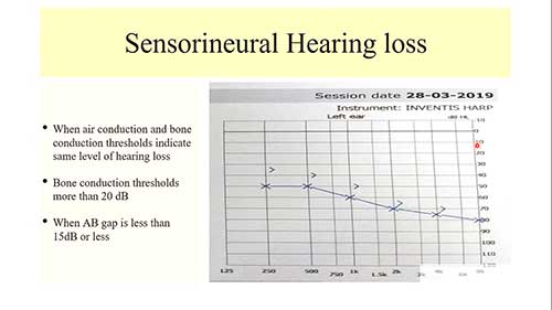 纯音听阈测试详解