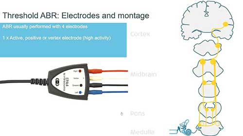 听性脑干反应02