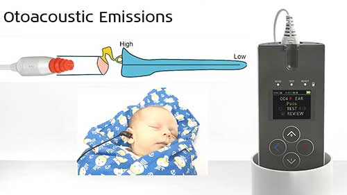 耳声发射与听性脑干反应