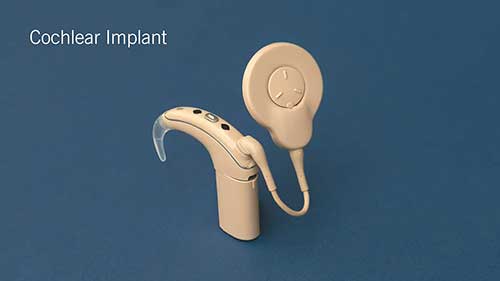 人工耳蜗与听力损失