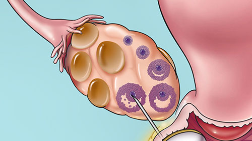 体外受精的原理