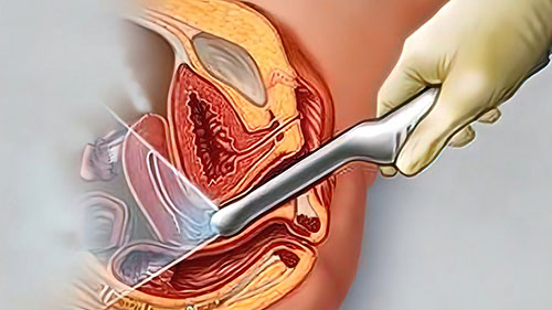 冷冻胚胎移植：取消移植