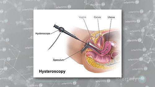 女性不孕症治疗：手术