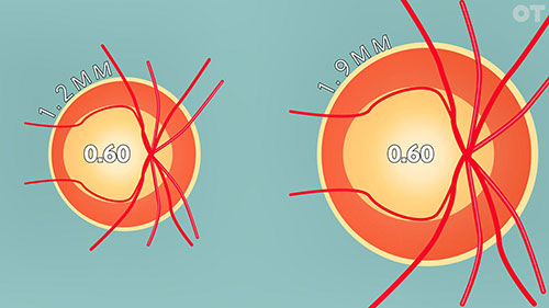眼科检查：测量杯盘比