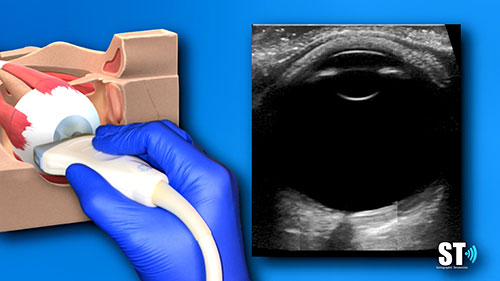 眼超声检查讲座