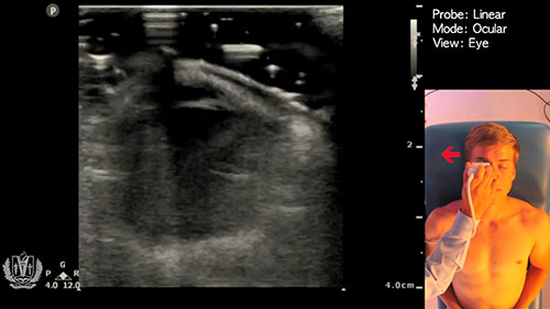 眼超声实际操作