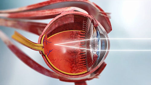 治疗近视的智能眼镜