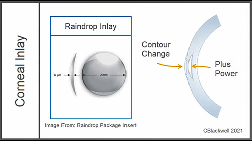 老视：手术治疗