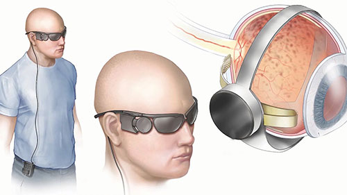 仿生眼为失明患者重启光明