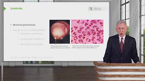 尿道炎的定义和病理介绍