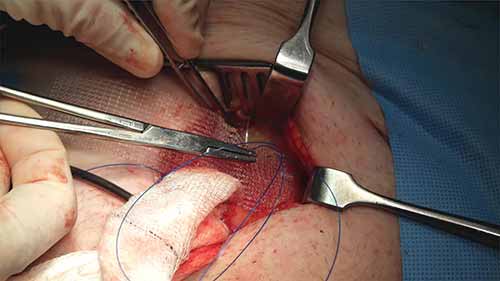 缝合5 缝合材料