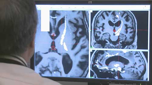 伽玛刀治疗特发性震颤