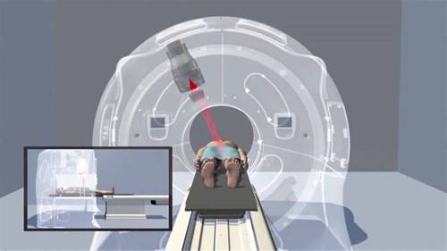 螺旋断层放疗系统的优点