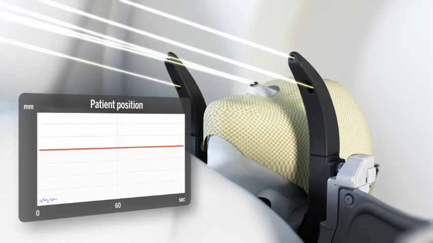 伽马刀治疗指南