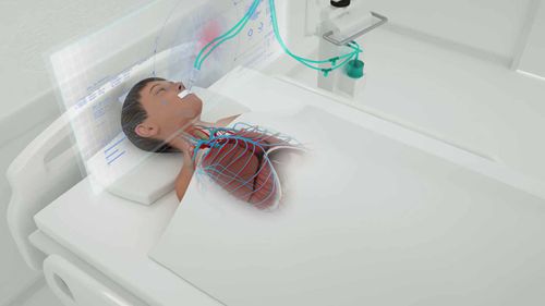 呼吸机与体外膜肺氧合