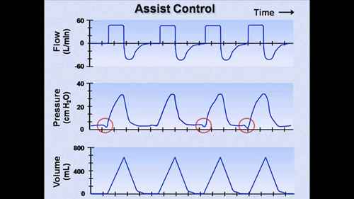 机械通气讲座 07 呼吸机模式
