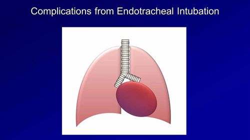 机械通气讲座 11 并发症